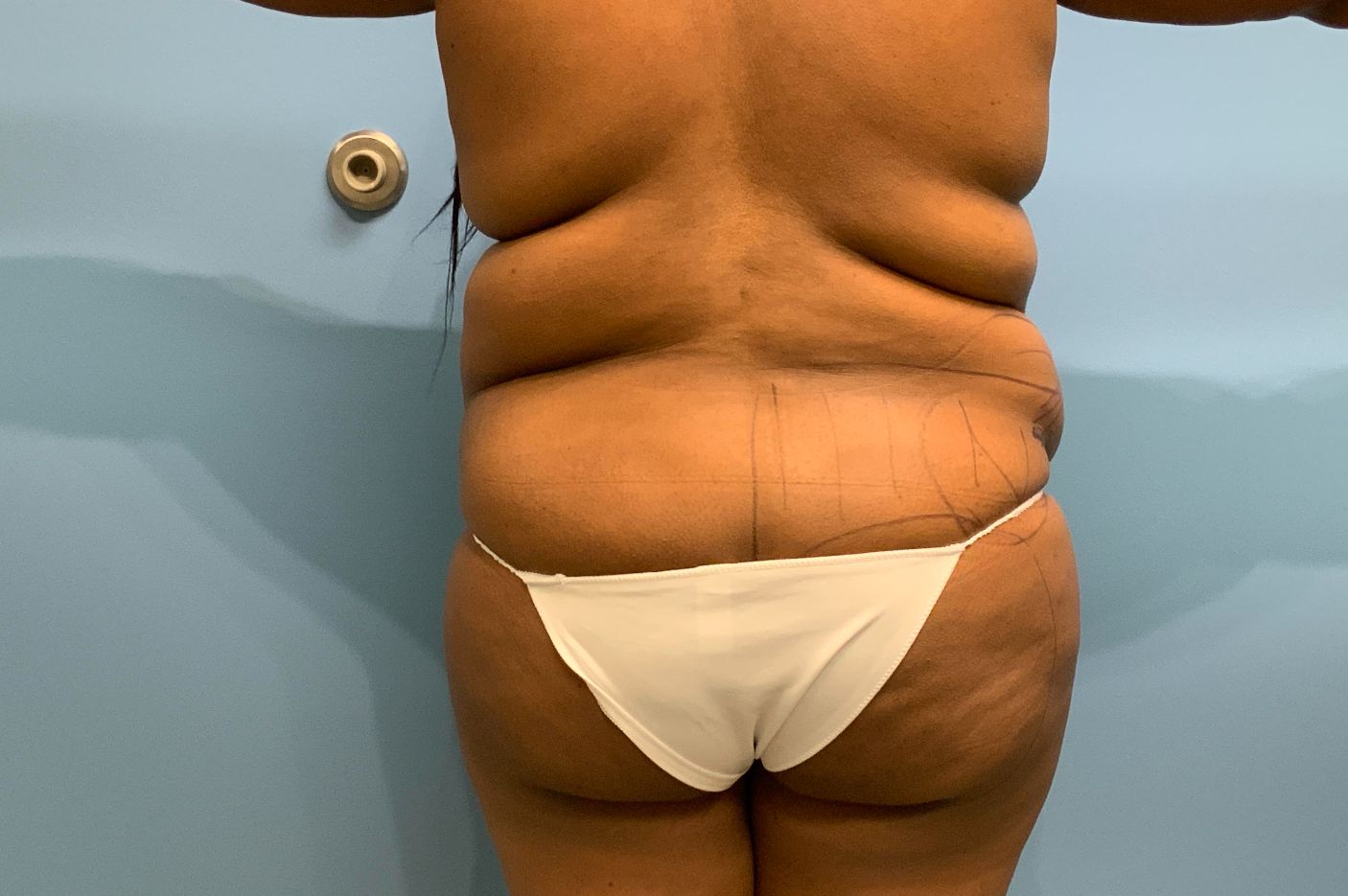 before liposuction back view female patient case 4247