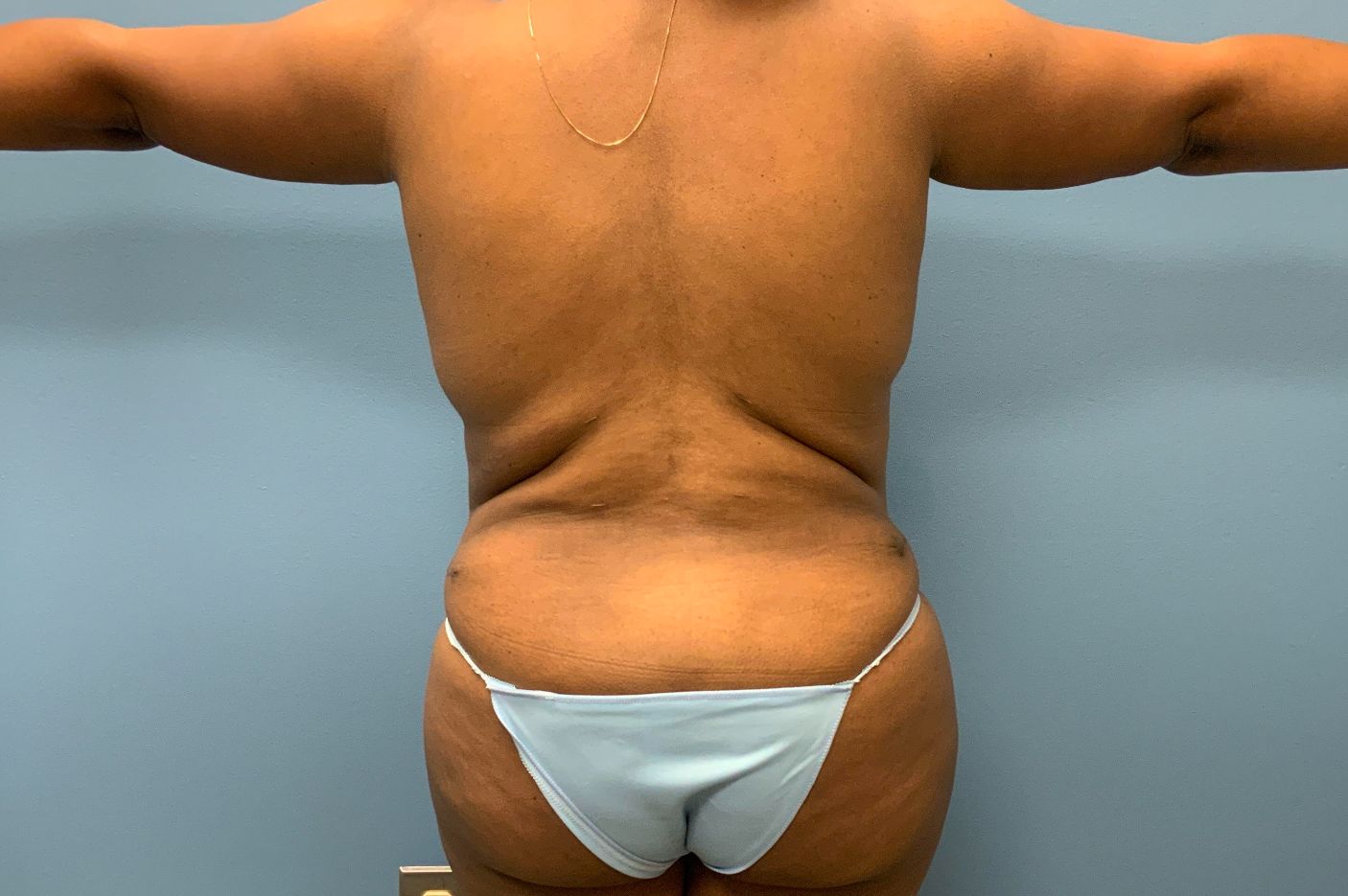 after liposuction back view female patient case 4247