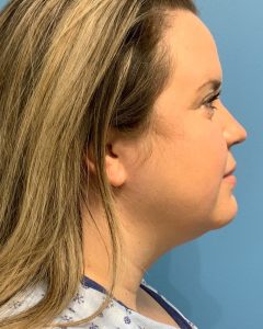 before neck lift right side view of female patient case 4236