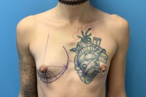 before transgender top surgery front view transgender patient case 4284