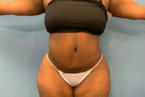 after tummy tuck front view female patient case 4253