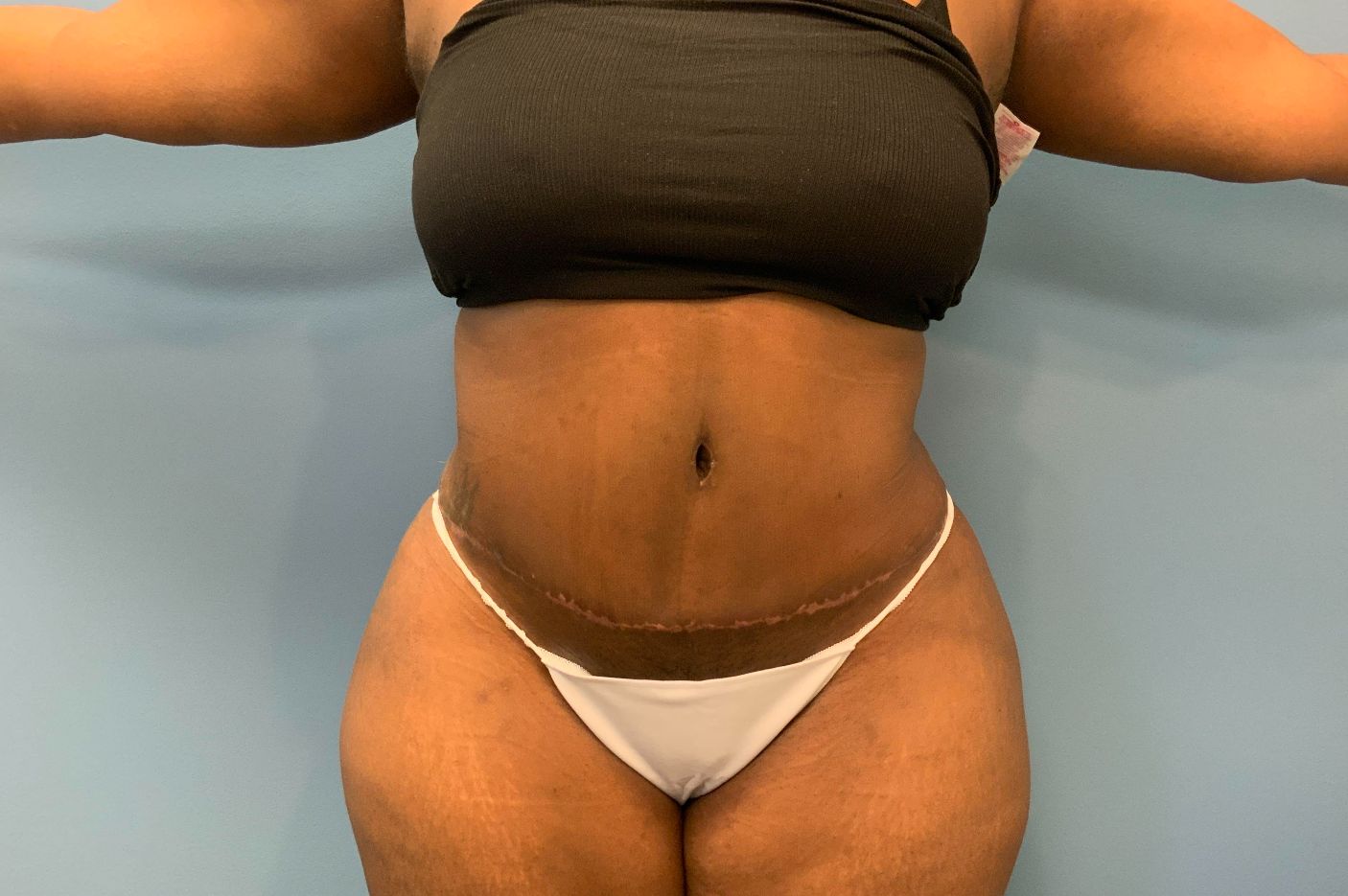 after tummy tuck front view female patient case 4253