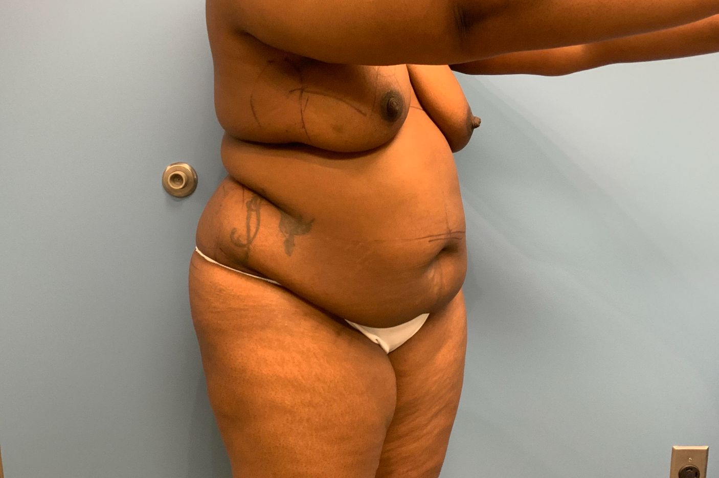before tummy tuck right angle view female patient case 4253