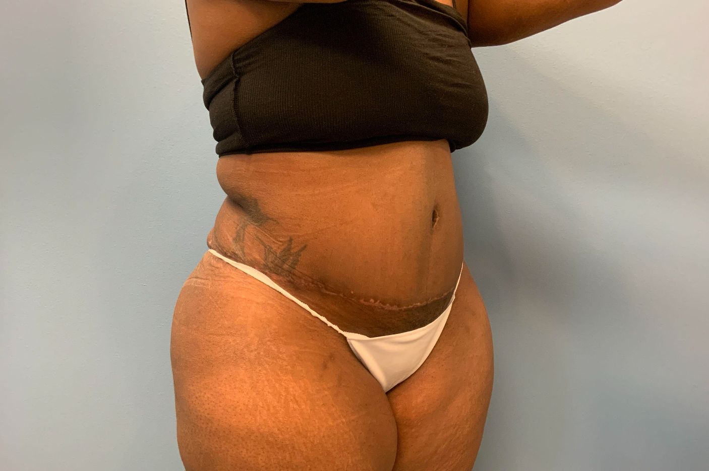 after tummy tuck right angle view female patient case 4253