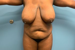 before tummy tuck front view female patient case 4263