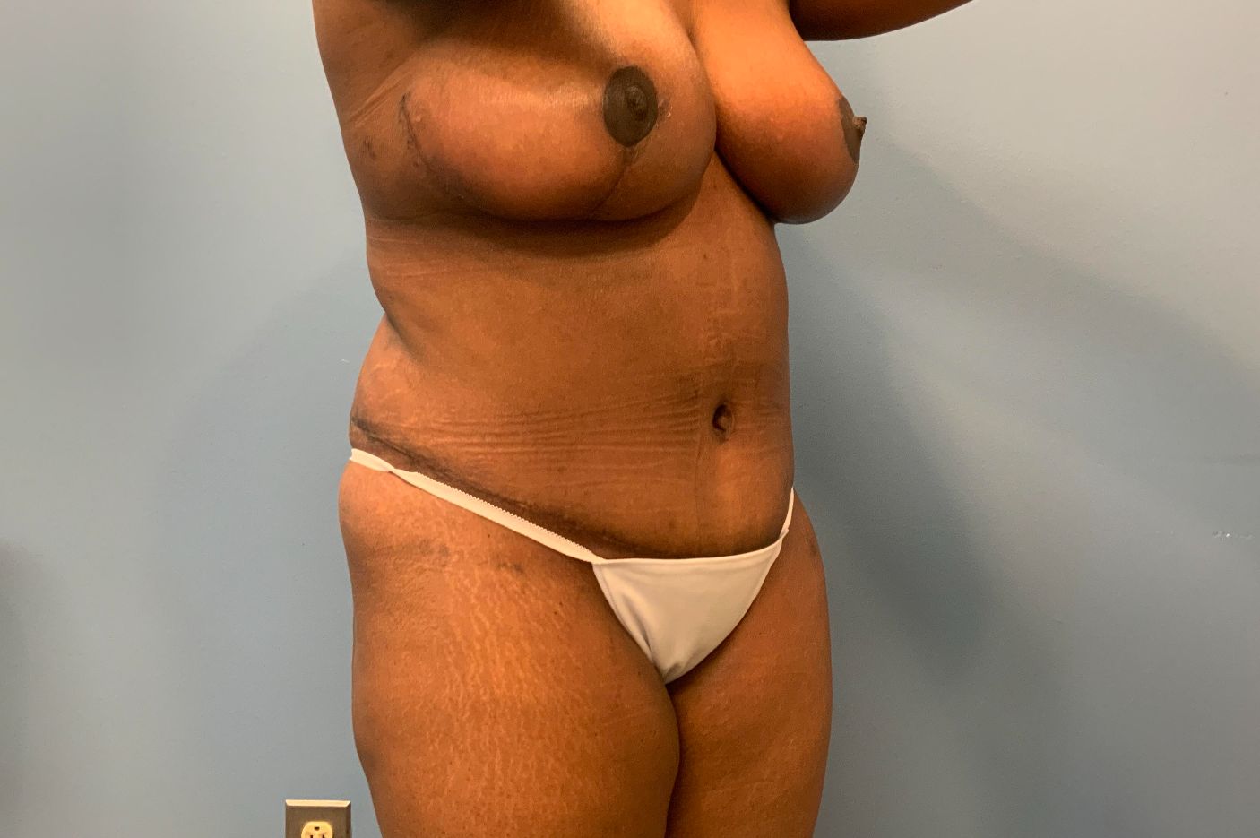 after tummy tuck right angle view female patient case 4263
