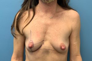 before breast augmentation front view female patient case 4470