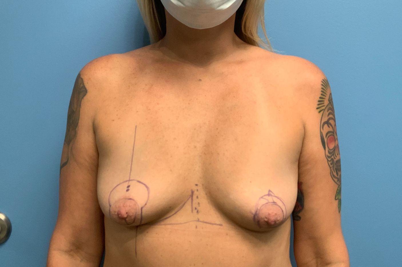 before breast augmentation front view female patient case 4475