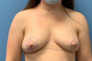 before breast augmentation lift front view female patient case 4547