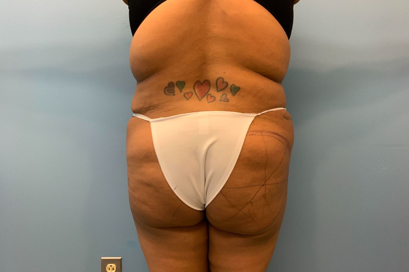 after liposuction back view female patient case 4543