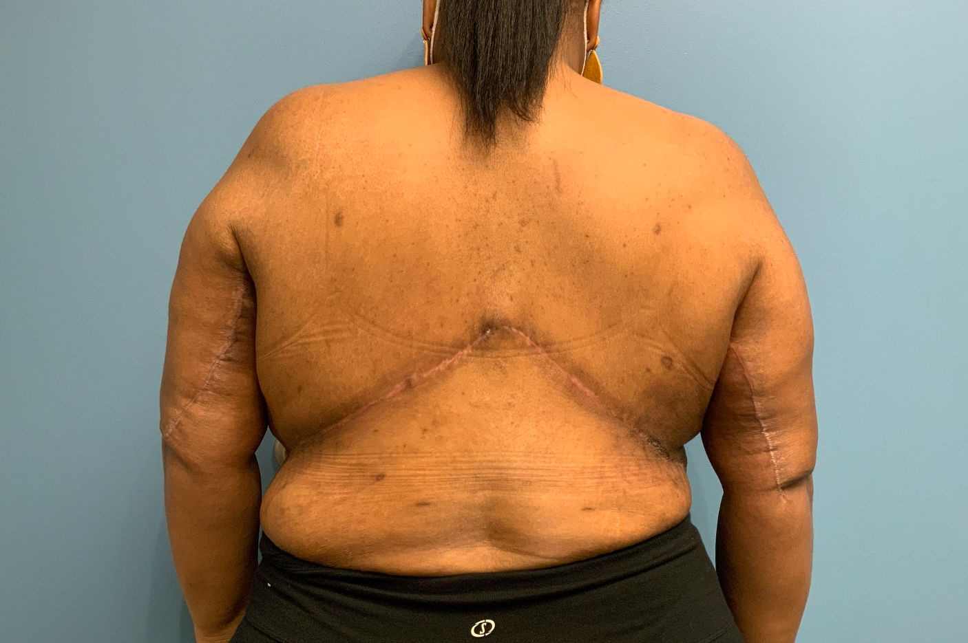 after surgery after weight loss back view female patient case 4500
