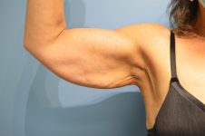 before surgery after weight loss front arm view patient case 4507