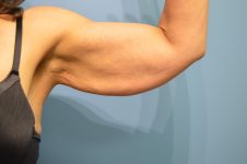 before surgery after weight loss front arm view patient case 4507