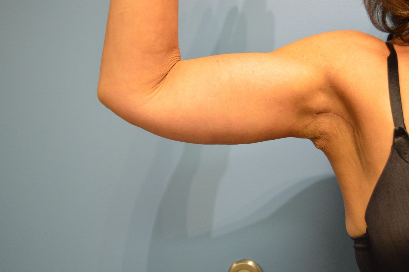 after surgery after weight loss front arm view patient case 4507