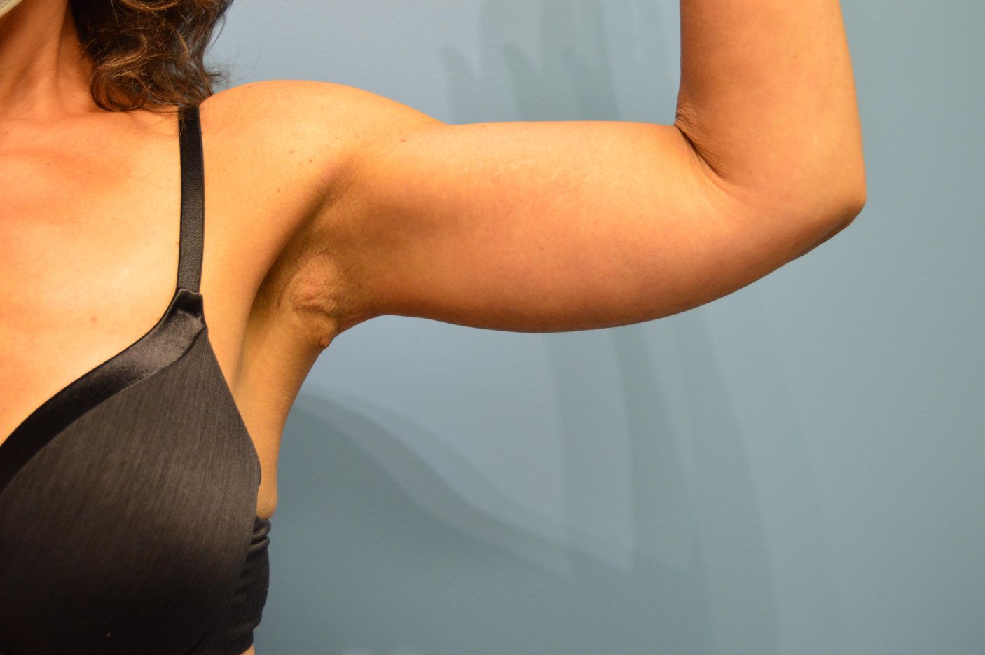 after surgery after weight loss front arm view patient case 4507