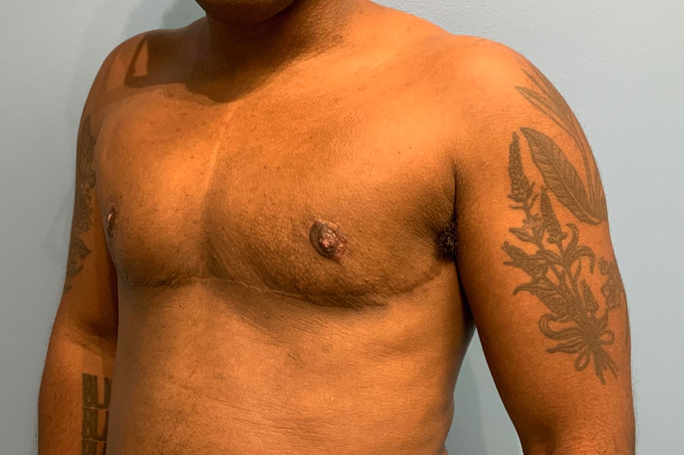 after transgender top surgery left view patient case 4528