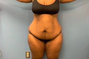 before tummy tuck front view patient case 4512