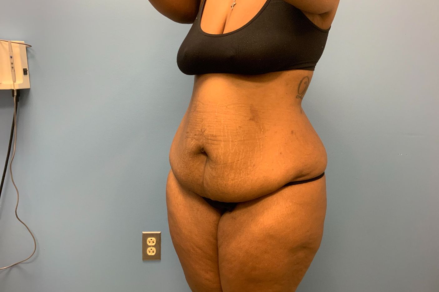 before tummy tuck left view patient case 4512