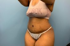 after tummy tuck left view patient case 4512