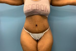 after tummy tuck front view patient case 4512