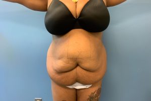 before tummy tuck front view patient case 4517