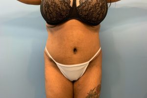 after tummy tuck front view patient case 4517