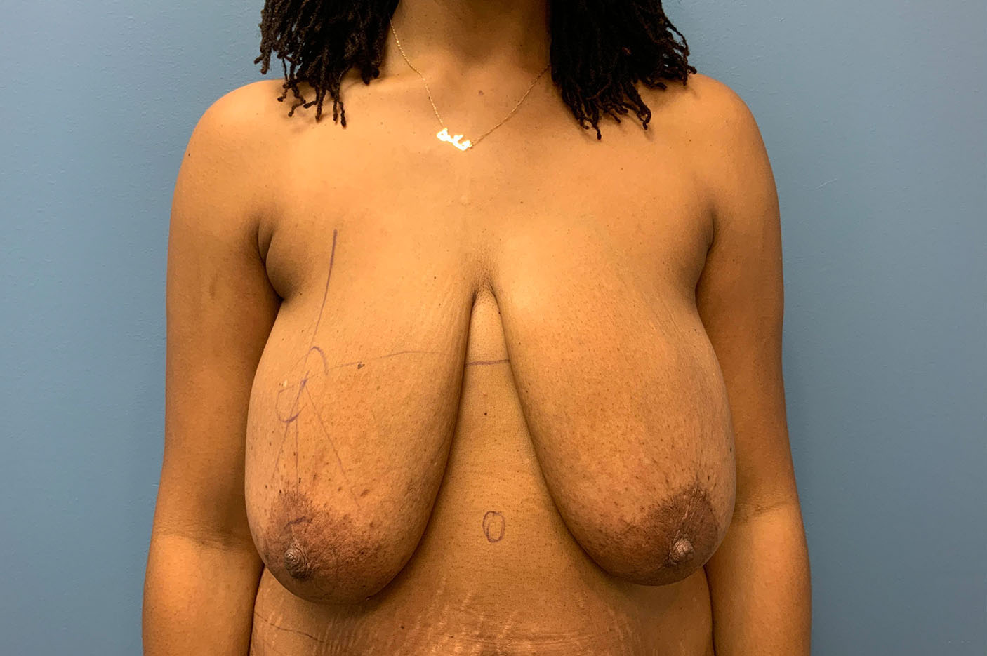 before breast lift front view of female patient case 4774