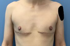 after transgender top surgery front view of patient case 4734