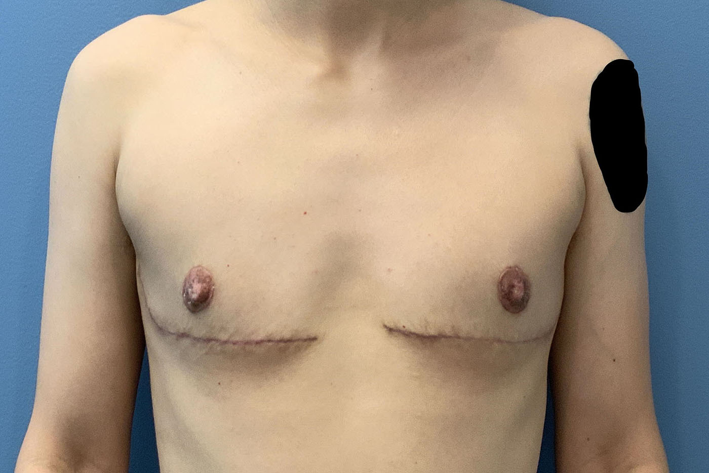 after transgender top surgery front view of patient case 4734