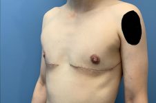 after transgender top surgery left angle view of patient case 4734