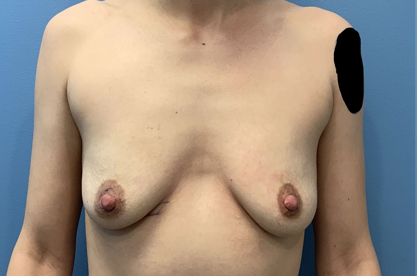 before transgender top surgery front view of patient case 4734