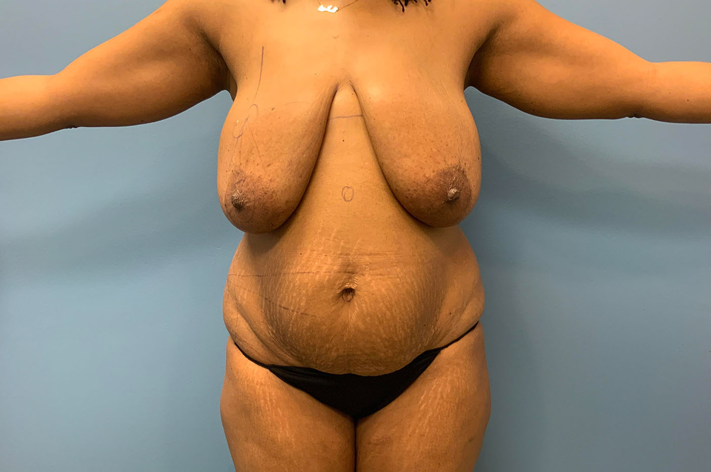 before tummy tuck front view of female patient case 4749