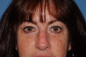 after blepharoplasty front view of female patient 5432