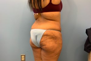 before Brazilian butt lift right back angle view of female patient 5447