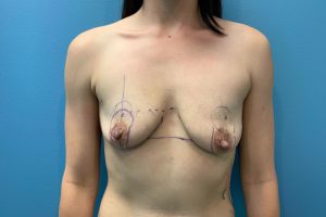 before breast augmentation with lift front view female patient case 5500