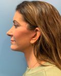 after facelift left side view of female patient 5437