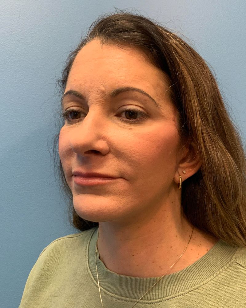 before facelift left angle view of female patient 5437