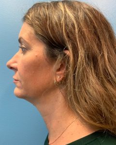 before facelift left side view of female patient 5437