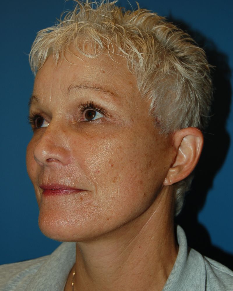 after facelift left angle view of female patient 5442