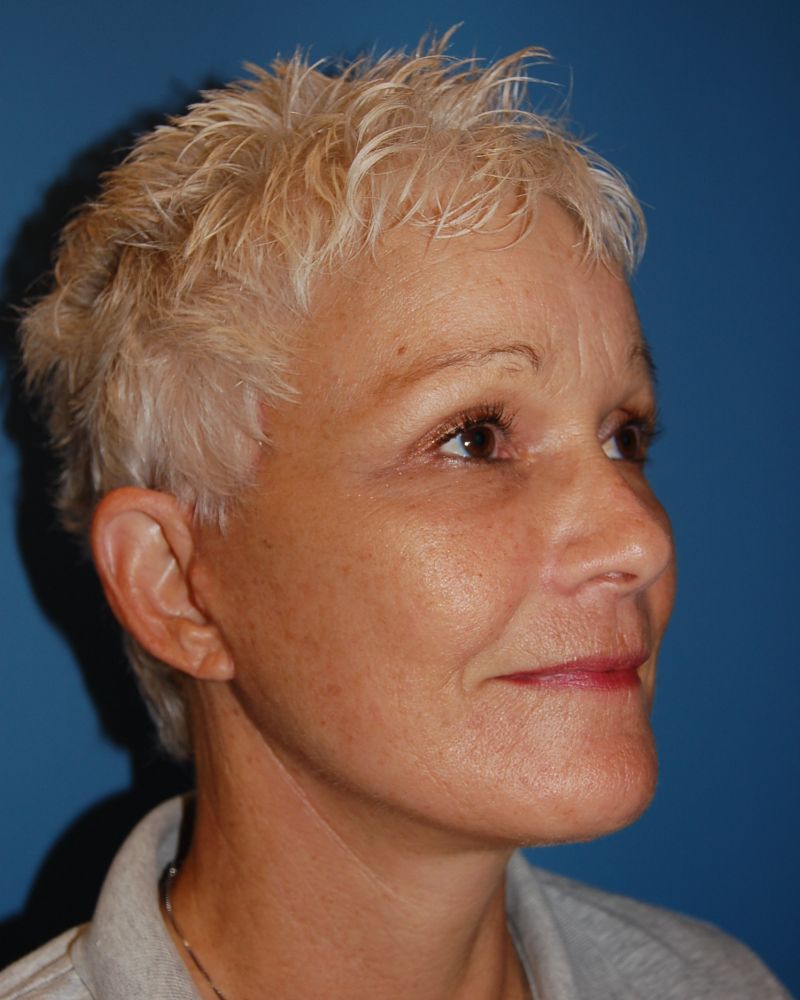 after facelift right angle view of female patient 5442