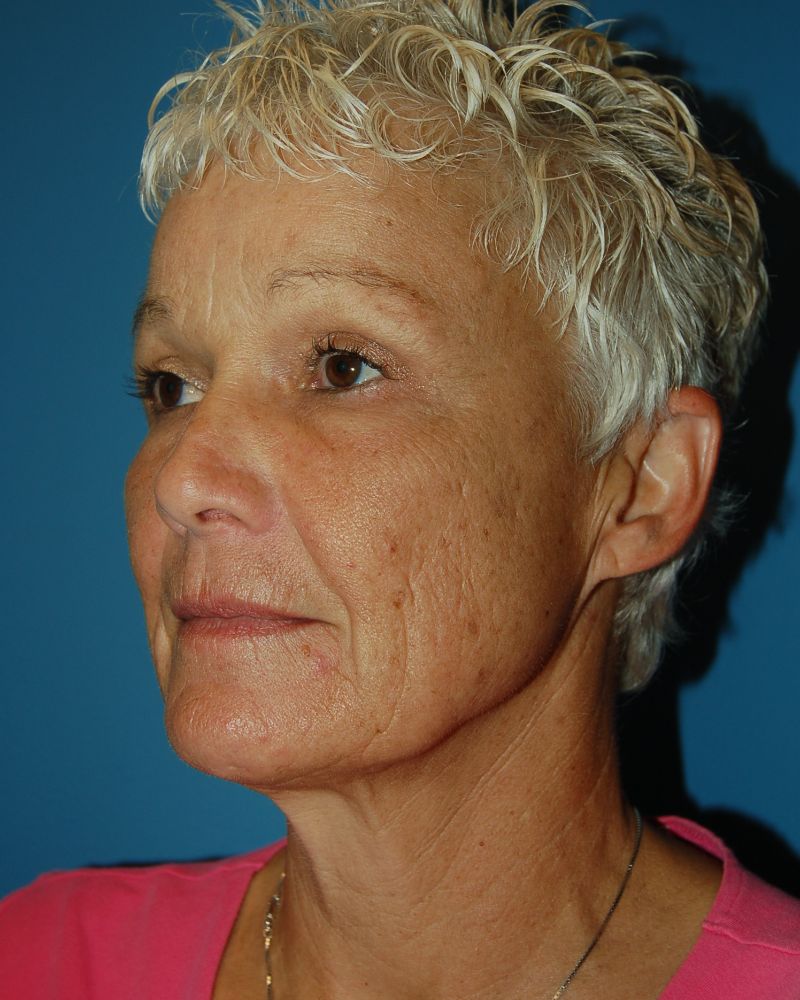 before facelift left angle view of female patient 5442