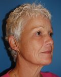before facelift right angle view of female patient 5442