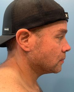 after neck lift right side view male patient case 5474