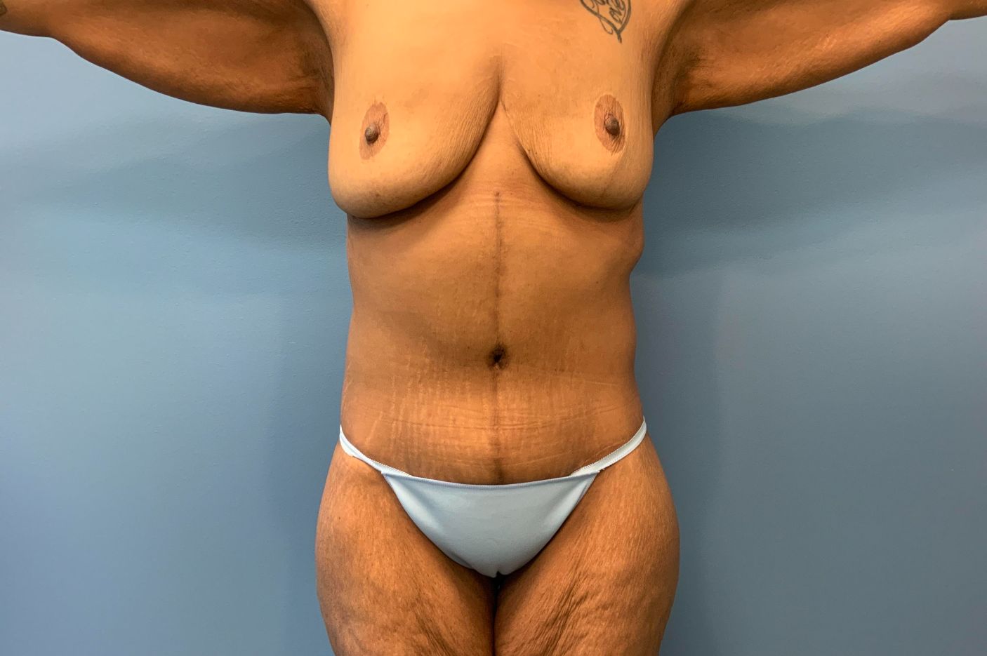 after surgery after weight loss front view female patient case 5488