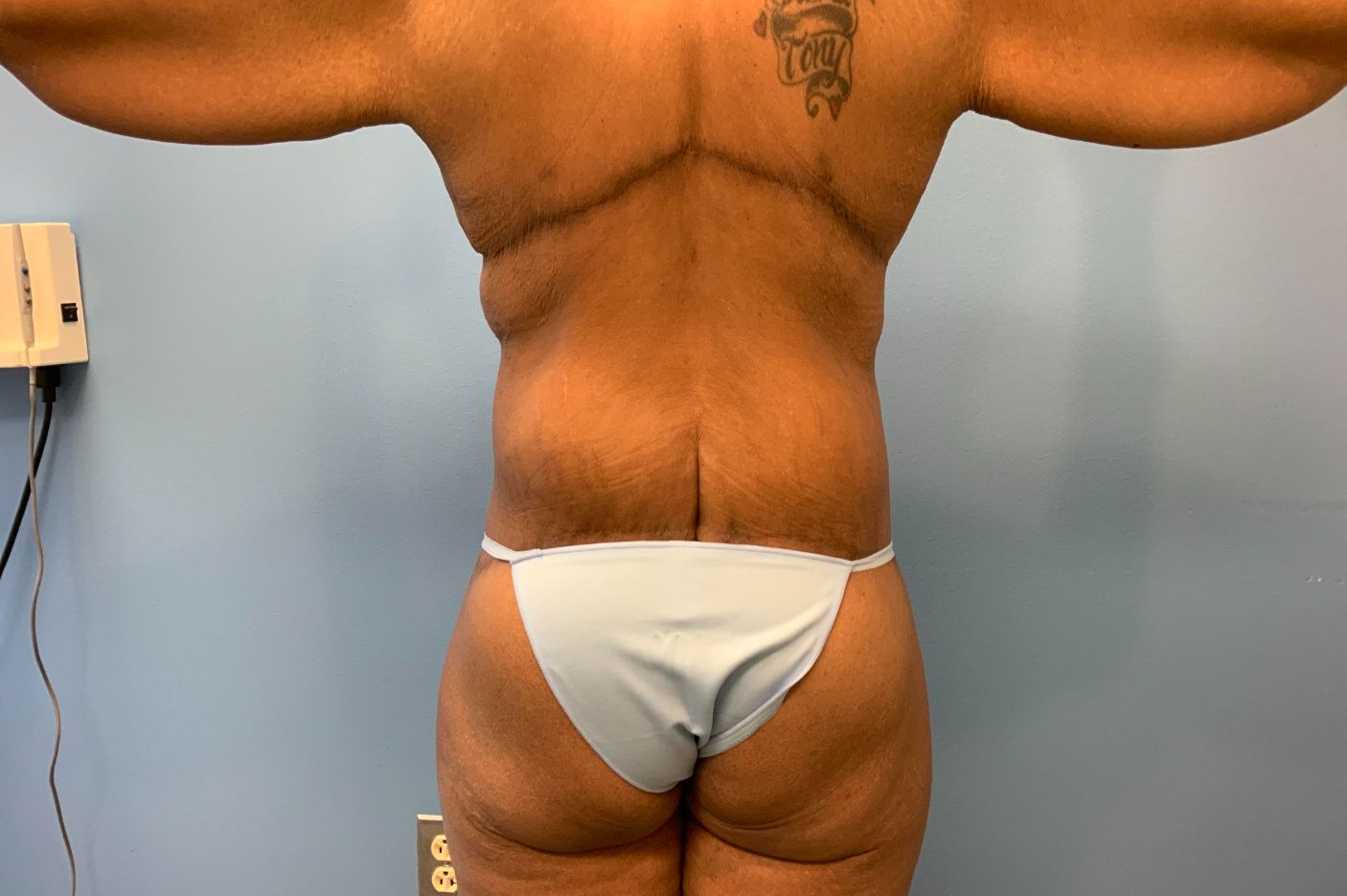 after surgery after weight loss back view female patient case 5488