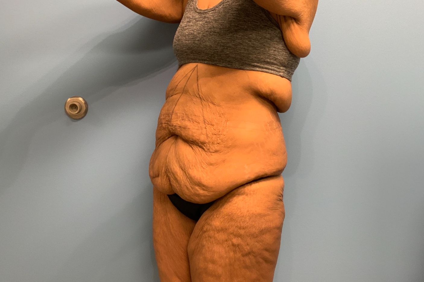 before surgery after weight loss left angle view female patient case 5488