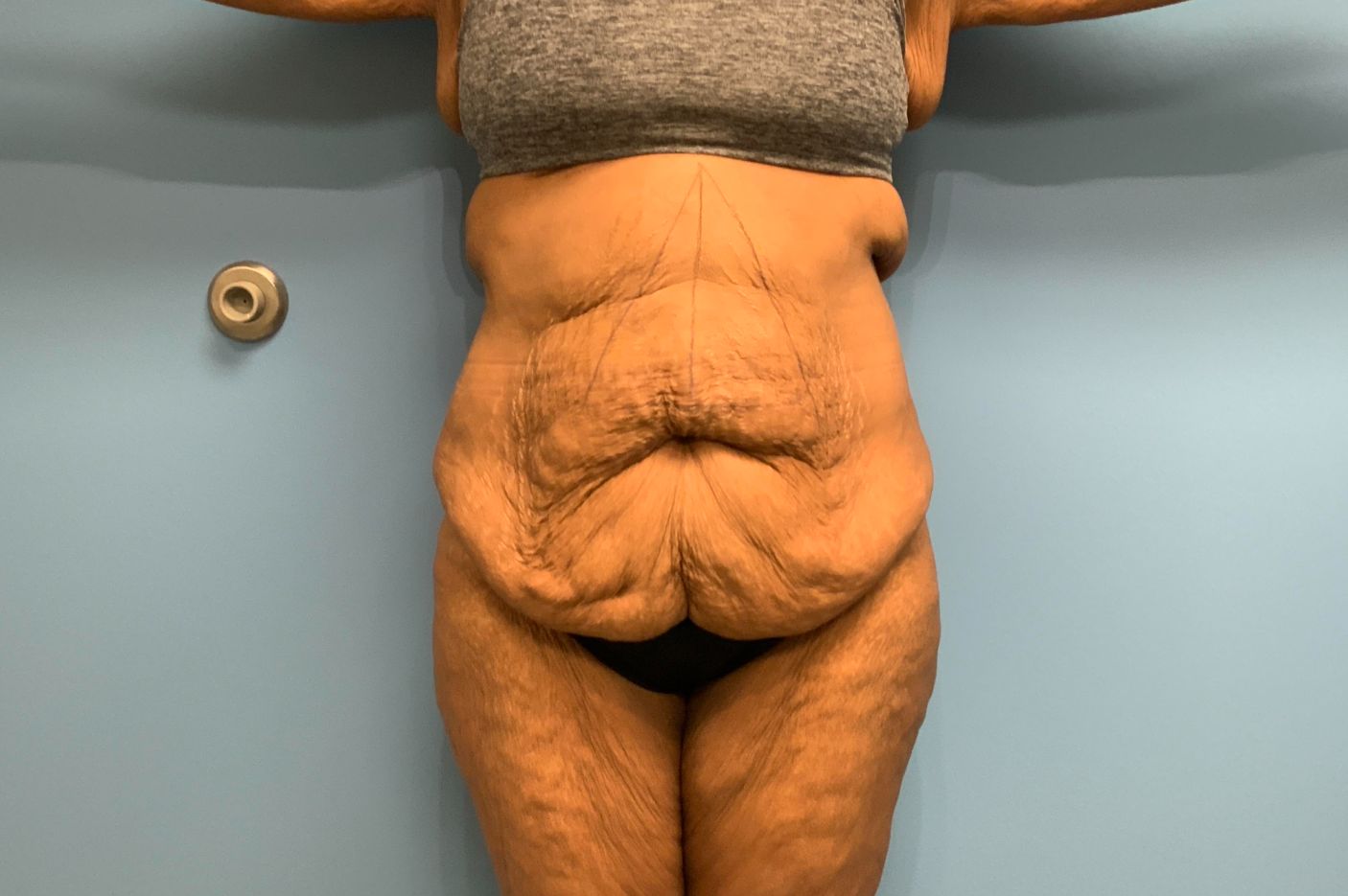 before surgery after weight loss front view female patient case 5488