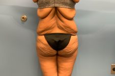 before surgery after weight loss back view female patient case 5488