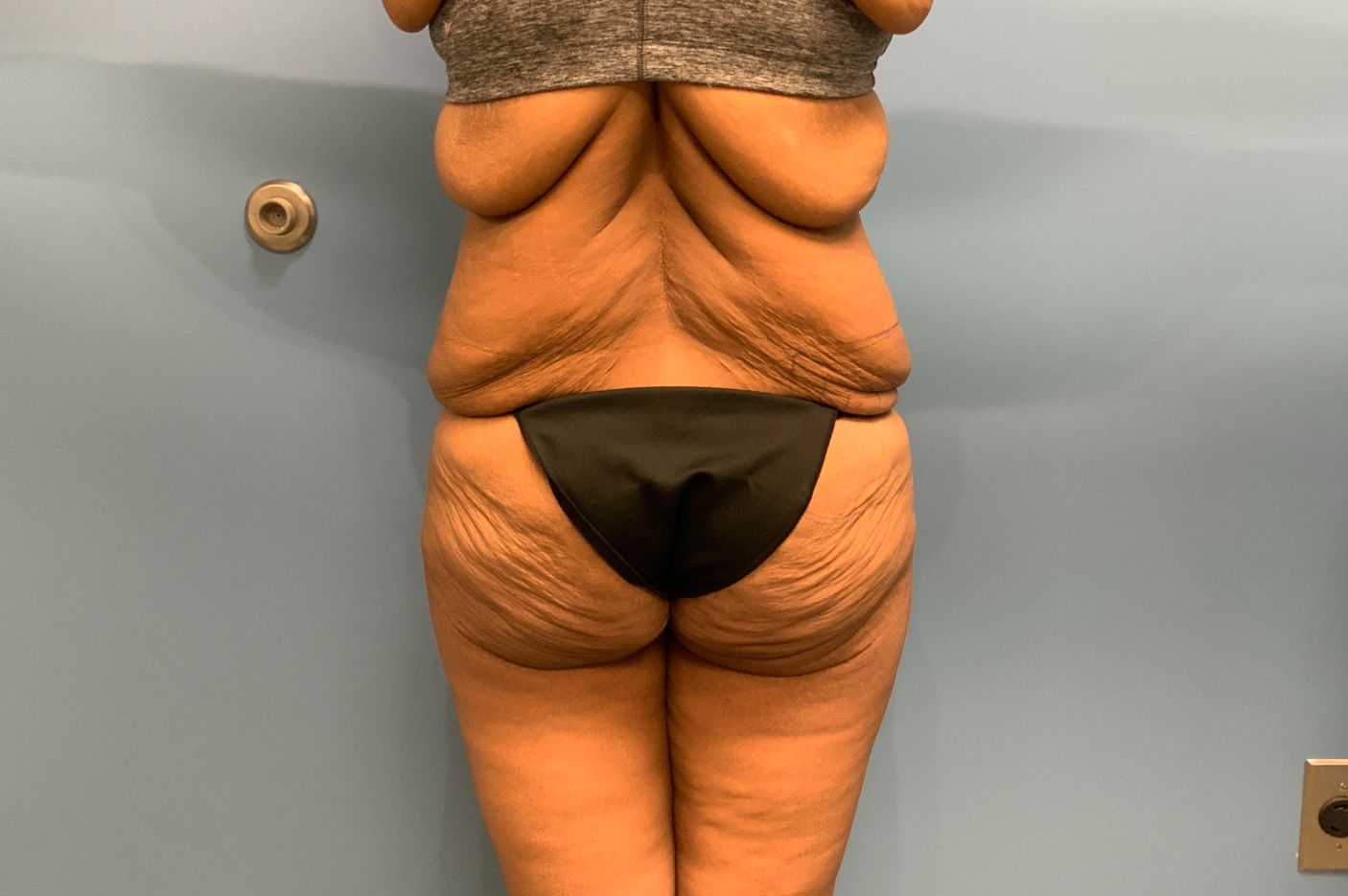 before surgery after weight loss back view female patient case 5488
