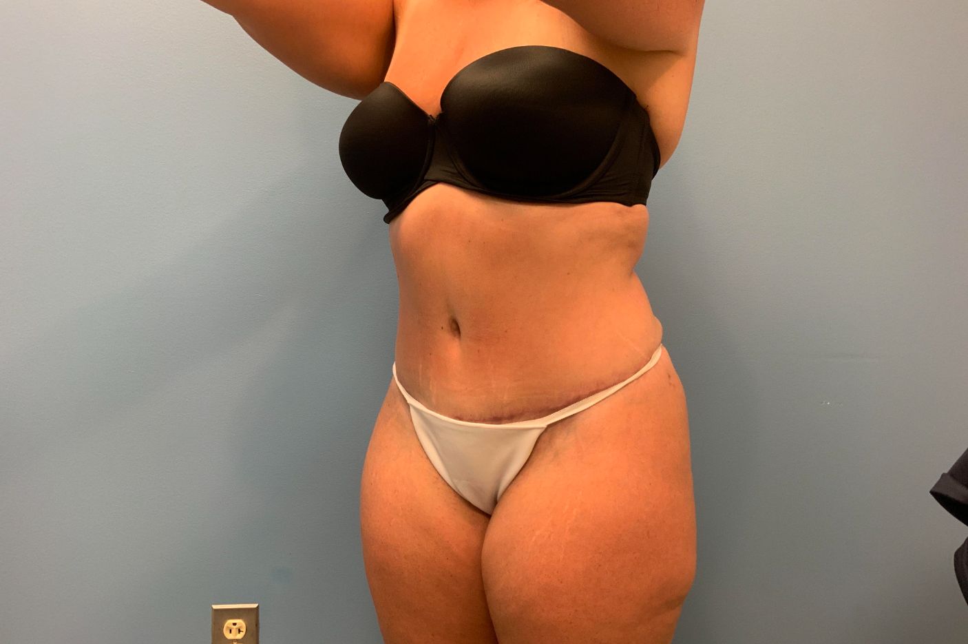 after tummy tuck left angle view female patient case 5452